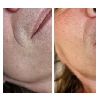 Dermapen tretman lica